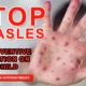 Stop Measles with Preventive Vaccination on your Child