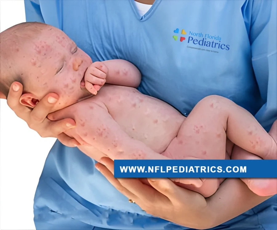 north-florida-pediatrics-measles-baby